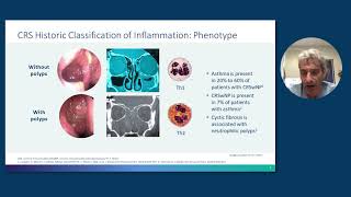 Rhinosinusitis With Nasal Polyps From Pathophysiology to Management [upl. by Dine]