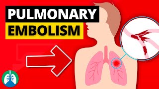 Pulmonary Embolism Medical Definition  Quick Explainer Video [upl. by Shanon]