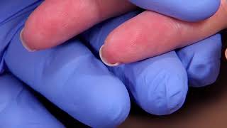 Perform a Capillary Puncture Obtain a Blood Sample by Capillary Puncture [upl. by Hedley]