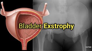 Understanding Bladder Exstrophy in newborn [upl. by Fernande368]