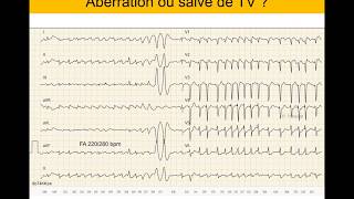 Tachycardie ventriculaire ou supraventriculaire  Quiz ECG Dr Taboulet [upl. by Zwick273]