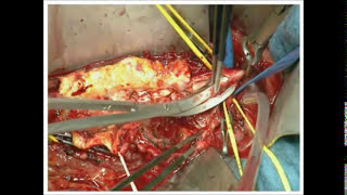 Vascular Pad Dilation Key Technique for Suturing Vascular Surgeries [upl. by Ainoet]