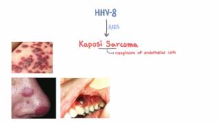 HHV8 and Kaposi Sarcoma [upl. by Baudoin]