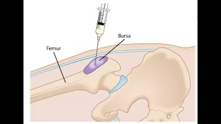 Greater Trochanteric Bursa Injection [upl. by Ellenrahc89]