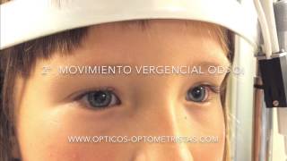 Movimientos oculares en el cover test con exoforia [upl. by Doti]