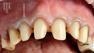 Teeth preparation with Retraction Cord  Smoothing Finishing and Contouring [upl. by Odella]