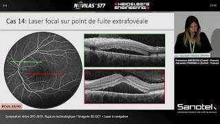 Cas cliniques au laser rétinien Navilas 577s  Dr Francesca AMOROSO et Dr Alexandre PEDINIELLI [upl. by Eimaral767]