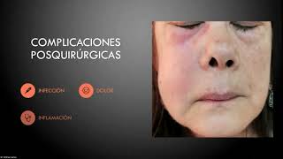 Alveolitis Complicación más frecuente en la tercera molar [upl. by Ennaxxor382]