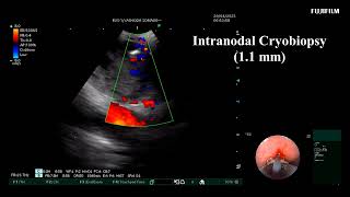 EBUS Intranodal Cryobiopsy  Mediastenal Ewings Sarcoma [upl. by Surtemed]