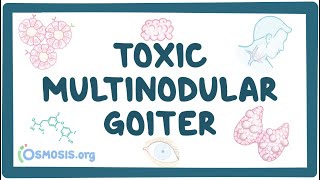 Toxic multinodular goiter  causes symptoms diagnosis treatment pathology [upl. by Mikel284]