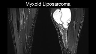 Myxoid Liposarcoma [upl. by Ygiaf]