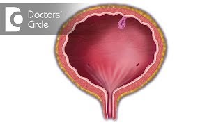 How is Bladder Cancer treated What is TURBT Dr Santosh Bethur [upl. by Aremahs]