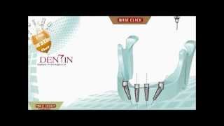 Dental Multi System DENTIN Implants Technologies Ltd [upl. by Corey]