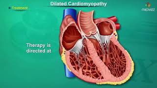 Dilated cardiomyopathy  DCM   Causes Signs and Symptoms Pathogenesis Diagnosis and Treatment [upl. by Justino61]