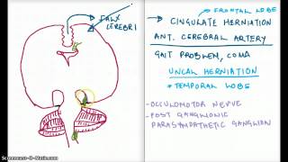 Easy Ways to Remember Cerebral Herniation [upl. by Abihsat681]