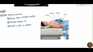 Ascites for USMLE Step 2 [upl. by Goar60]