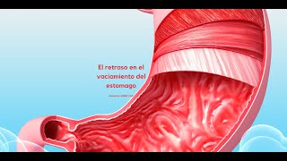 Retraso en el vaciamiento gastrico o Gastroparesis [upl. by Rahman]