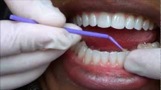 139 FIXING ISSUE WITH PERMANENT RETAINERS ON MY TEETH [upl. by Irish]