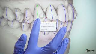 iTero Element™  Invisalign® Progress Assessment [upl. by Nlyak]