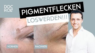 Cryopen entfernt Pigmentflecken sicher amp schnell [upl. by Abbey]