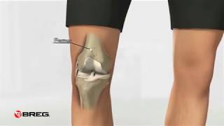 Breg OA Unloader Knee Braces For Osteoarthritis [upl. by Leanahtan345]