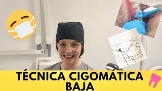 Técnica Cigomática Baja [upl. by Karola560]