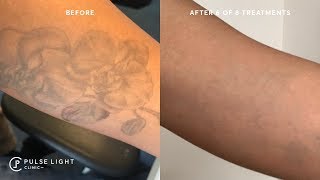 GETTING RID OF MY TATTOOS FOREVER  Tattoo Removal on Dark Skin [upl. by Skoorb]