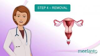 How to use menstrual cup  indepth explanation video [upl. by Idrahs]