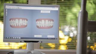 Invisalign® Outcome Simulator Demo Video [upl. by Greenman439]