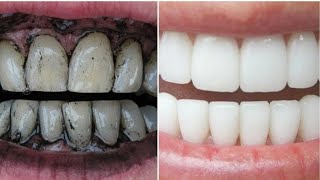 कितने भी गंदे पिले दांतों मोती सा चमकदार बनाना देता है ये फ्री का उपाय  teeth whitening [upl. by Bunde]