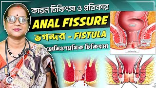 ফিস্টুলা থেকে মুক্তির উপায়  fistula homeopathic treatment in bangla  anal fissure  bhagandar [upl. by Lorita859]