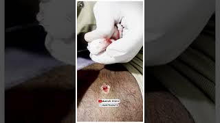 Get Rid of Warts Quickly and Easily Easy and PainlessAWISH Clinic [upl. by Ole188]