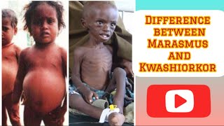 Marasmus and Kwashiorkor difference between marasmus and Kwashiorkor hindi pediatricnursing [upl. by Nylrem]