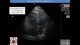 POCUS Cases 2 Pulmonary Embolism [upl. by Gleda]