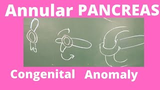 Annular pancreas  Congenital anomaly of pancreas  Embryology of Pancreas easy to write in exams [upl. by Eyahs]