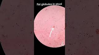 Fat globules in stool [upl. by Aisayt]