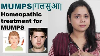 Mumps गलसुआ Homeopathic treatment and Medicines for MUMPS [upl. by Hardej706]