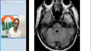 Radiology Spotters by Dr Sumer Sethi 34  Wallerian Degeneration [upl. by Aleil]