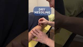 Dry Needling  Tennis Elbow  Treatment [upl. by Lisk]