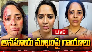 అనసూయ ముఖంపై బలమైన గాయాలు anasuyabharadwaj anasuya 24media [upl. by Anilyx890]