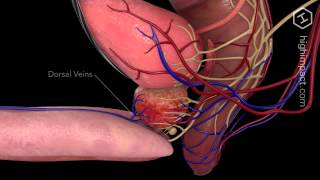 Open Prostatectomy [upl. by Aldis]