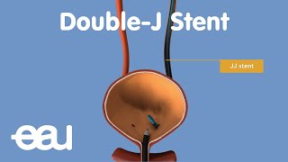 JJ Stent removal of kidney stones [upl. by Anidan]