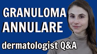 Granuloma annulare treatments and causes dermatologist Dr Dray [upl. by Htebasyle]