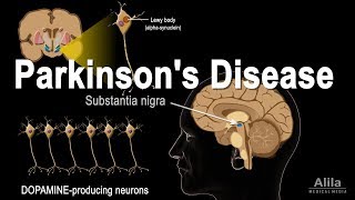 Parkinsons Disease Animation [upl. by Inerney]