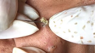 ACNE BLACKHEADS WHITEHEADS REMOVAL on face 38  How to get rid of pimple easy part [upl. by Affer]