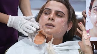 Transgender Women Plastic Surgery  Pack Removal 7th Day [upl. by Ijat]