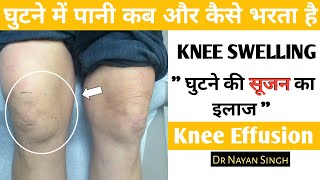 घुटने की सूजन Knee effusion Treatment swelling in knee joint घुटने में पानी भरना ghutne ki sujan [upl. by Vigen]