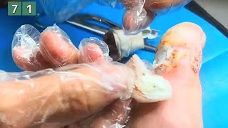 71Periungual wart on big toe [upl. by Eannaj587]