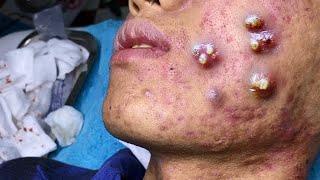 cystic acne blackhead whitehead removal  Relaxing Spa Acne Treatment [upl. by Sirotek]