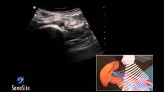 How To Abdominal Aorta Ultrasound 3D Video [upl. by Amby952]